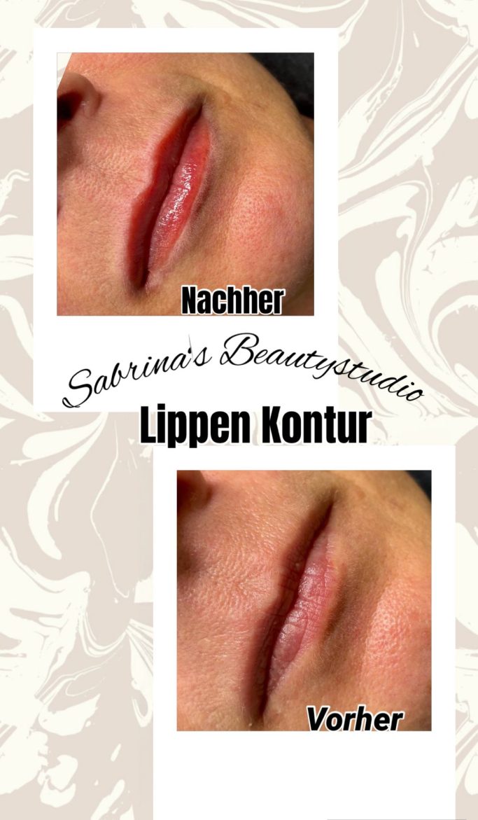 Lippenkontur-Behandlung mit Vorher- und Nachher-Bildern.